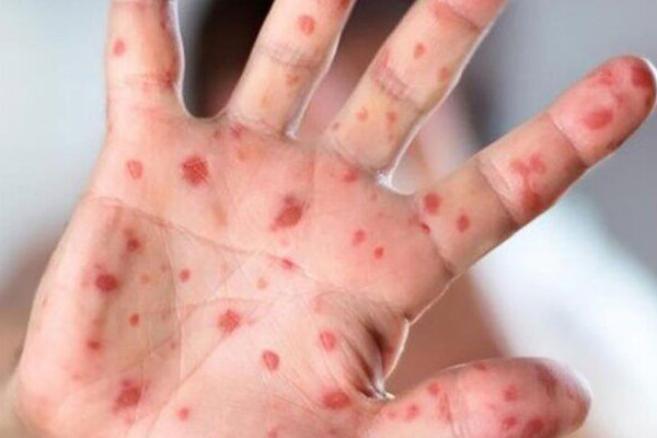 ابتلای ۹۶ نفر به سرخک در کشور / وزارت بهداشت: تزریق واکسن ضروری است ابتلای ۹۶ نفر به سرخک در کشور / وزارت بهداشت: تزریق واکسن ضروری است