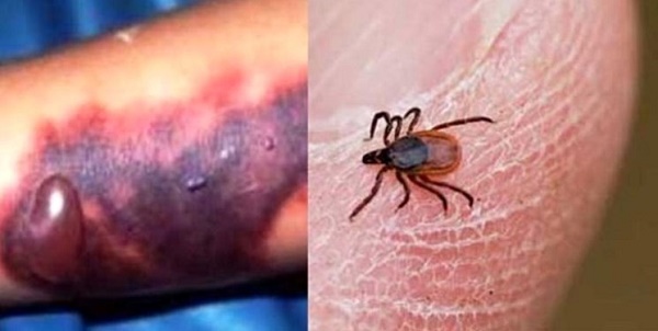 شناسایی ۲ مورد ابتلاء به تب کریمه کنگو در کشور شناسایی ۲ مورد ابتلاء به تب کریمه کنگو در کشور