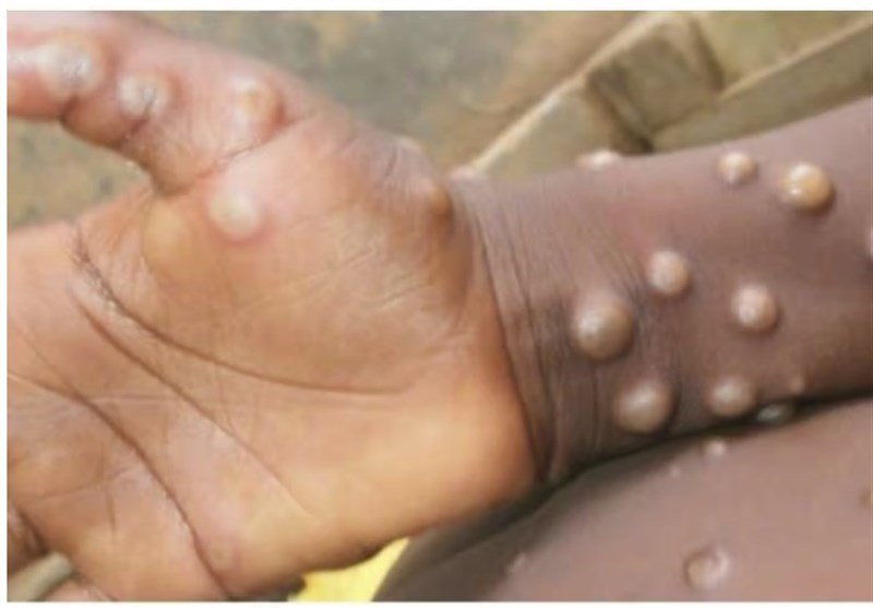 شناسایی ۶ بیمار مشکوک به آبله میمونی در کشور/ تست اولیه ۳ بیمار منفی است شناسایی ۶ بیمار مشکوک به آبله میمونی در کشور/ تست اولیه ۳ بیمار منفی است