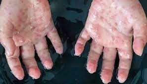 علائم جدید ابتلا به آبله میمونی علائم جدید ابتلا به آبله میمونی
